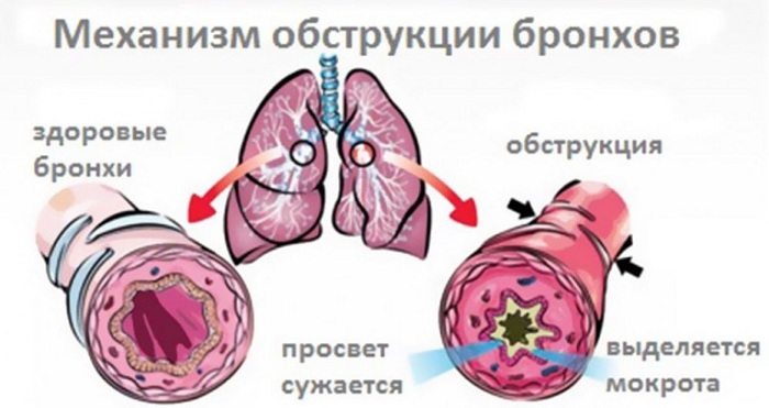 Механизм обструкции