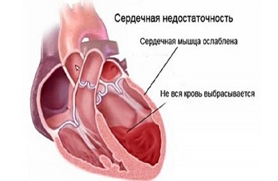 Сердечная недостаточность