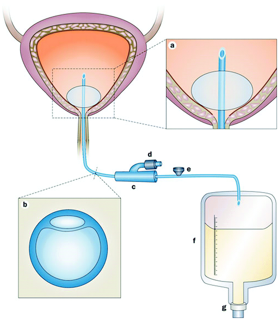 Можно греть мочевой пузырь. Цистостома мочевого пузыря катетер. Цистостома катетер Фолея. Катетер Фолея в мочевом пузыре у женщин. Схема катетера для мочевого пузыря.