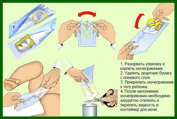 как собрать мочу у грудничка мальчика мочеприемником