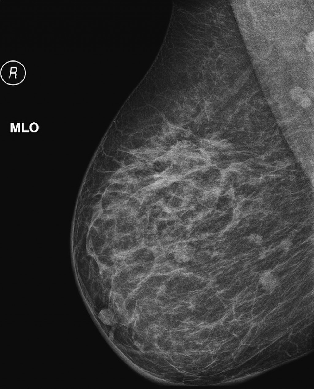 Маммография уплотнения. Фибросаркома молочной железы. Метастазы молочной железы маммография. Метастазы в молочной железе на маммографии. Фибросаркома маммография.