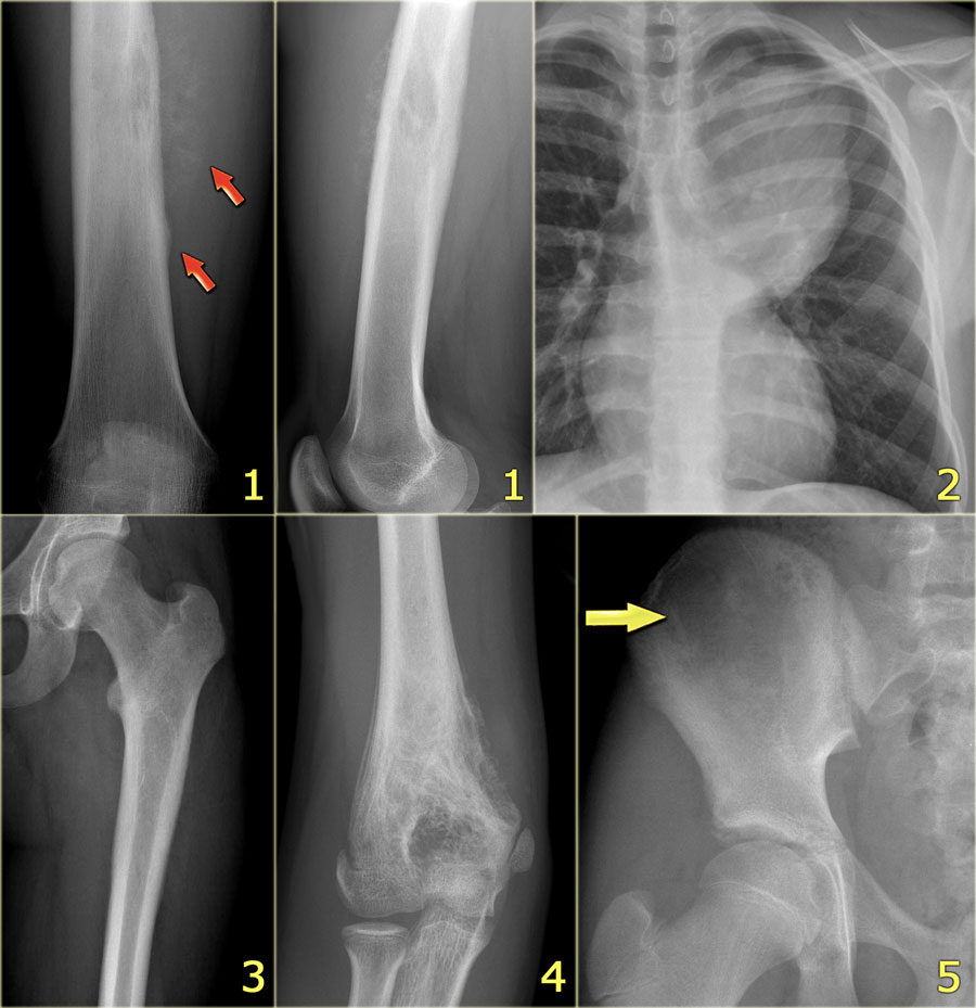 Симптомы костей. Саркома Юинга трубчатой кости.
