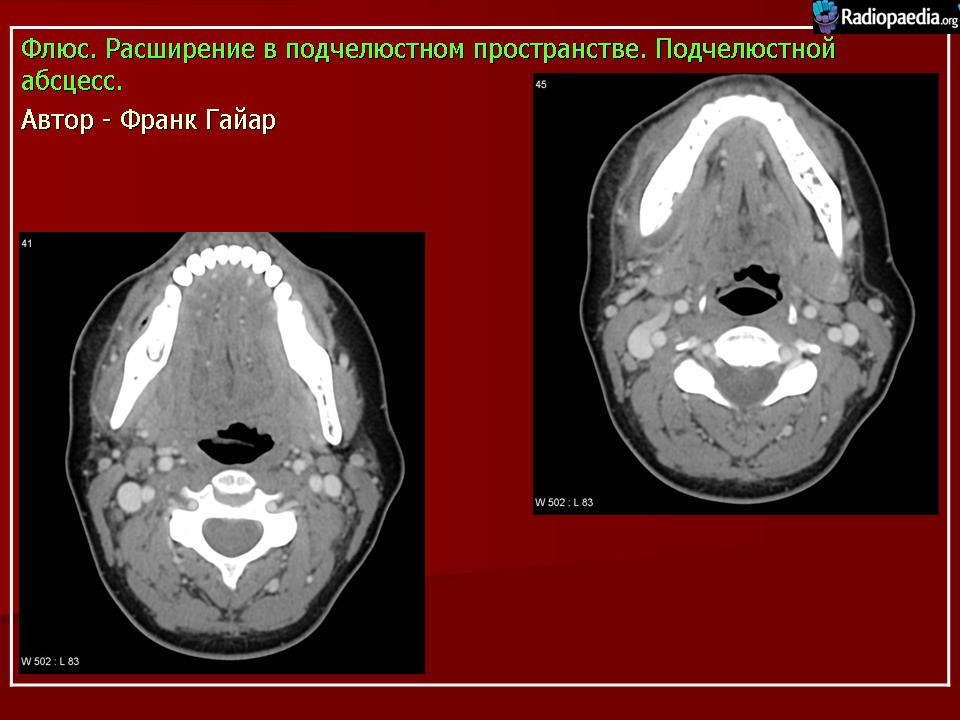 Паратонзиллярный абсцесс локальный статус карта вызова смп