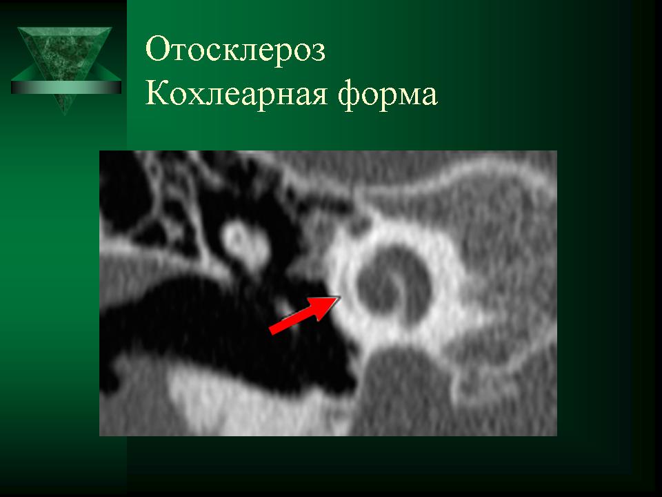 Отосклероз по утвержденным клиническим рекомендациям. Фенестральный отосклероз на кт. Смешанная форма отосклероза кт. Отосклероз височной кости на кт. Отосклероз на кт височных костей.