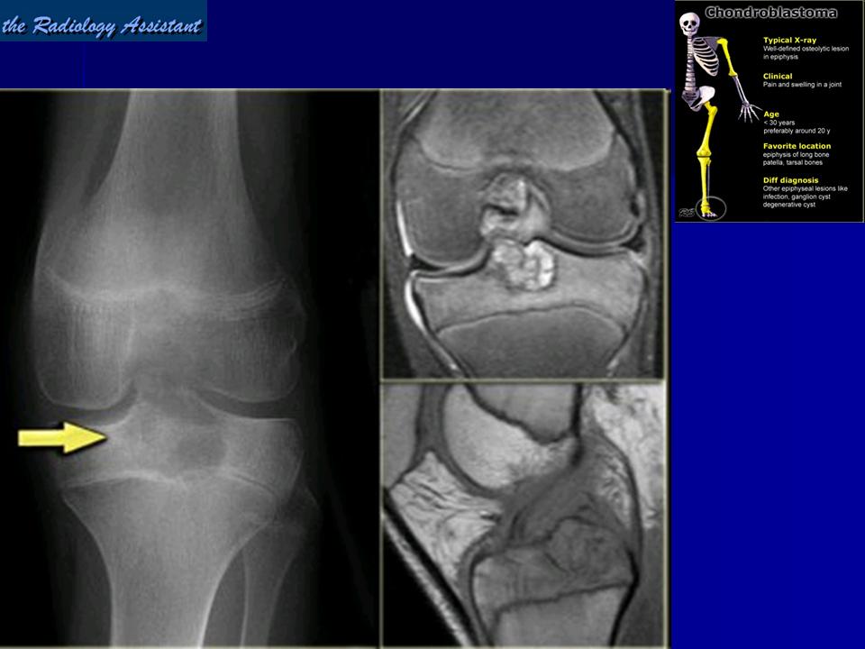 Хондробластома. Хондробластома бедренной кости. Хондробластома большеберцовой кости рентген. Хондробластома бедренной кости кт. Доброкачественная хондробластома.