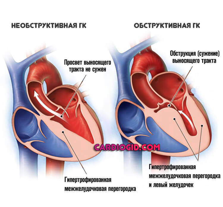 Миокард правого желудочка сердца. ГКМП обструктивная форма. Обструктивная форма гипертрофической кардиомиопатии. Обструктивная гипертрофия кардиомиопатия. Кардиомиопатия левого желудочка.