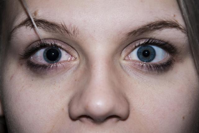  операция субдуральная гематома