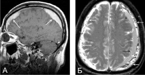 субдуральная гематома у детей