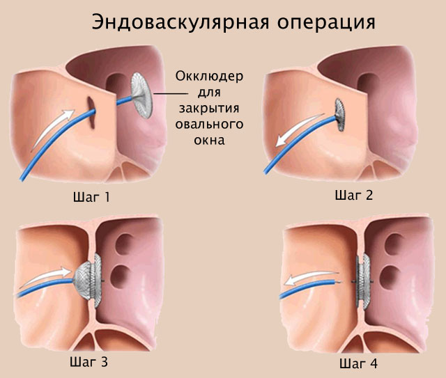 Эндоваскулярная операция по закрытию ОО в сердце