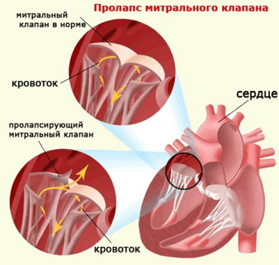 Пролапс МК