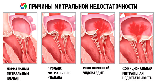 Причины митральной недостаточности 