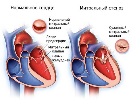 Митральный стеноз