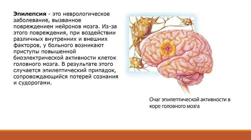 Судороги мозга. Заболевание эпилепсия. Эпилепсия симптомы в неврологии. Эпилепсия головной мозг.