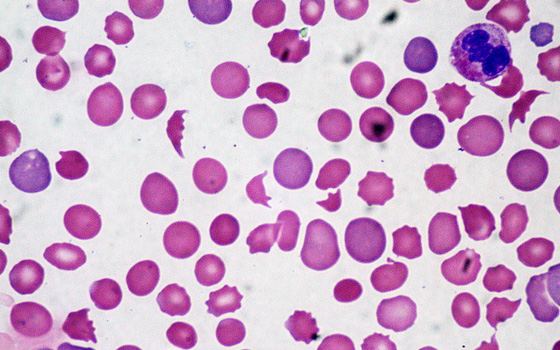 фото: кровь при гемолитической анемии. Эритроциты - неправильной формы