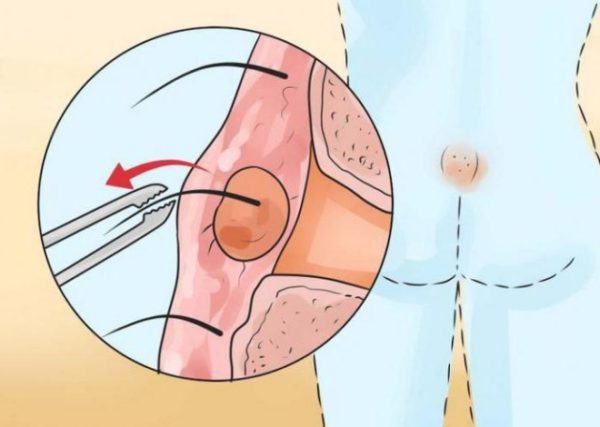 Киста на копчике у мужчин