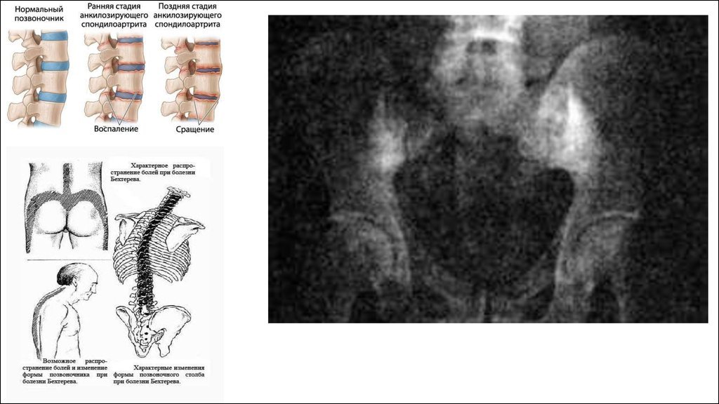Артроз реберно позвоночных сочленений. Болезнь Бехтерева крестцово подвздошное сочленение. Болезнь Бехтерева рентген сакроилеит. Рентген болезнь Бехтерева крестцово подвздошное сочленение. Сакроилеит при болезни Бехтерева.
