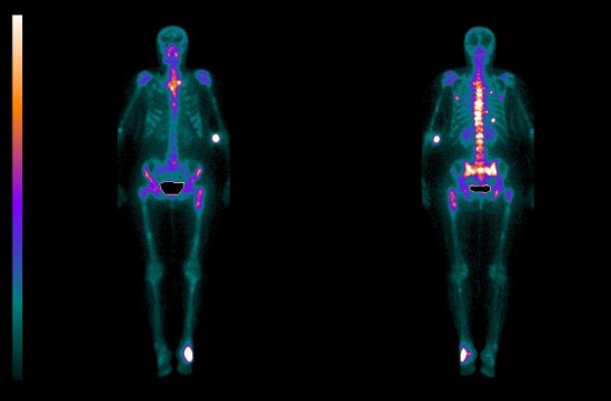 Сцинтиграфия костей скелета