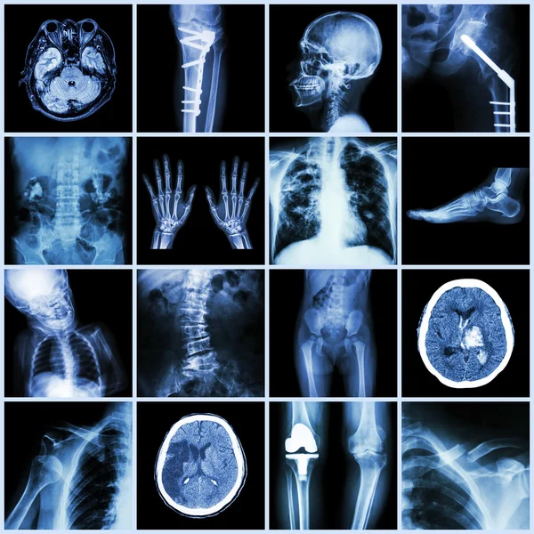 Set of X-ray multiple part of human,Multiple disease,orthopedic,surgery (Stroke,Bone fracture,Orthopedic operation,Kidney stone,Arthritis,Gout,Pulmonary tuberculosis,Heart disease,Scoliosis,etc) Stock Photo