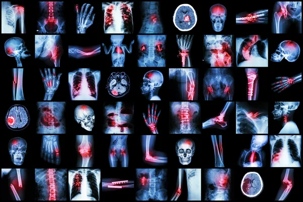 X-ray multiple disease of child and adult ( Stroke , Arthritis , Fracture , Tuberculosis , Brain tumor , Bowel obstruction  , Kidney stone , Spondylosis , Spondylolisthesis , Osteoarthritis knee ,etc) Stock Photo