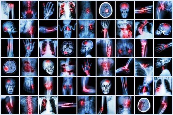 X-ray multiple disease of child and adult ( Stroke , Arthritis , Fracture , Tuberculosis , Brain tumor , Bowel obstruction  , Kidney stone , Spondylosis , Spondylolisthesis , Osteoarthritis knee ,etc) Royalty Free Stock Images