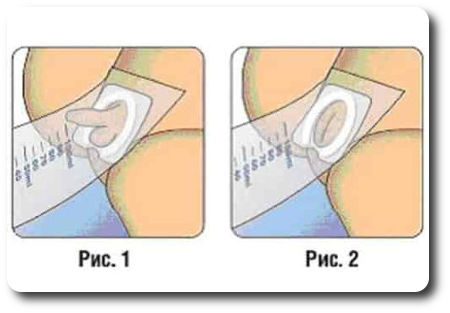 Как собрать мочу у девочки грудничка мочеприемником
