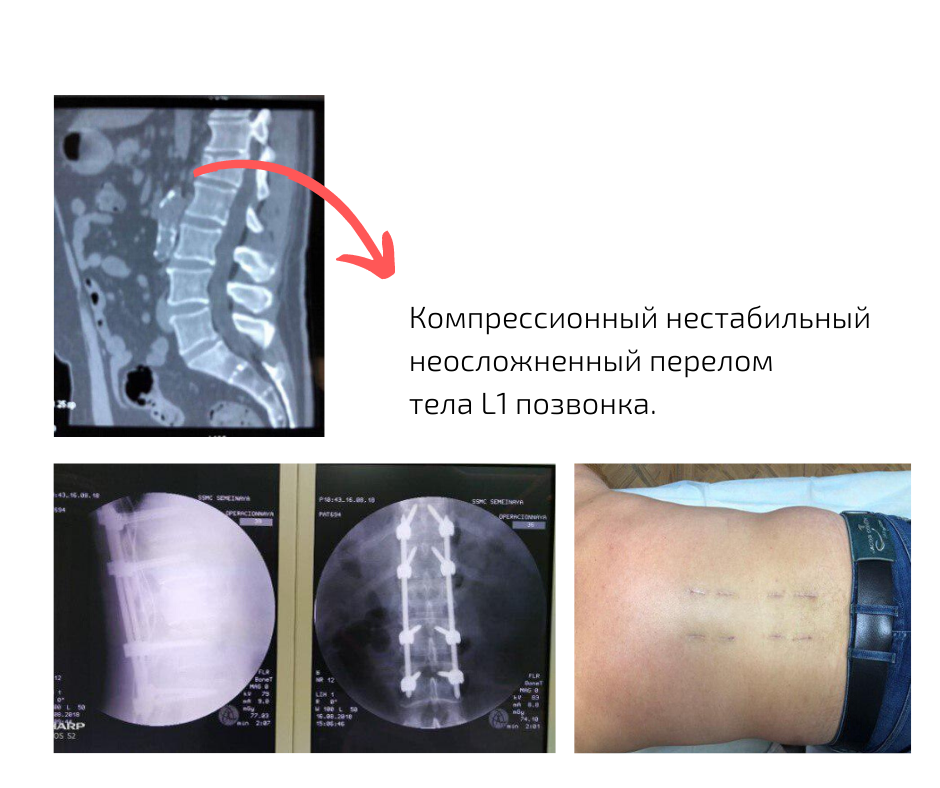 Компрессионный перелом позвоночника последствия