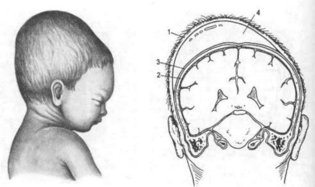 Поражение мозга у новорожденных. Кефалогематома пункция. Кефалогематома у новорожденных. Кефалогематома и родовая опухоль. Кефалогематома рентген.