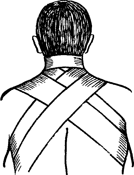 Крестообразная на затылок. Техника наложения восьмиобразной повязки на затылочную область. Крестообразная (восьмиобразная) повязка. Восьмиобразная повязка на затылок и шею. Крестообразная повязка на шею.