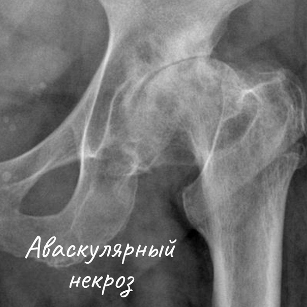 Некроз шейки бедра. ТБС рентген асептический некроз. Некроз головки тазобедренного сустава на рентгене. Эностоз шейки бедренной кости кт. Рентген асептический некроз бедренной кости.