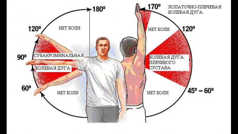 Поднятие руки в плечевом суставе. Болит плечо при поднятии руки. Дуга Дауборна. Плечевой сустав болит при поднятии руки. Болит плечевой сустав левой.