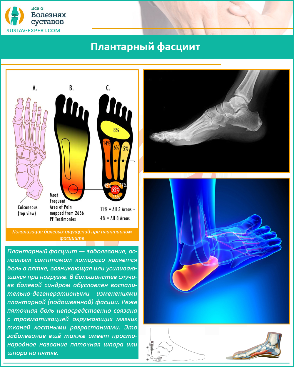 Плантарный фасциит