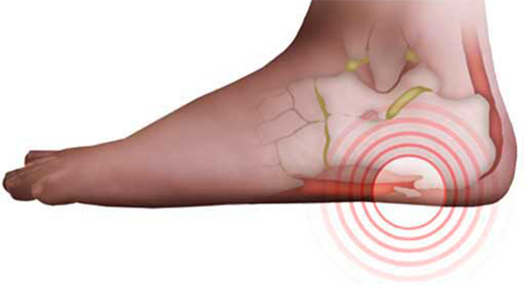 Пяточная шпора - симптомы и лечение в домашних условиях