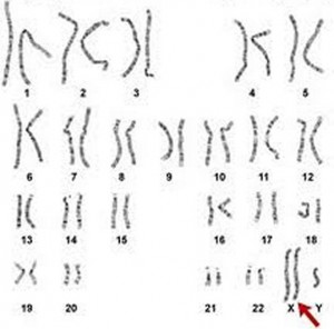 Klinefelter Syndrome Karyotype pics