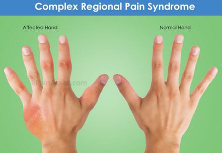 complex regional pain syndrome image