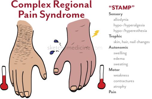 complex regional pain syndrome symptoms