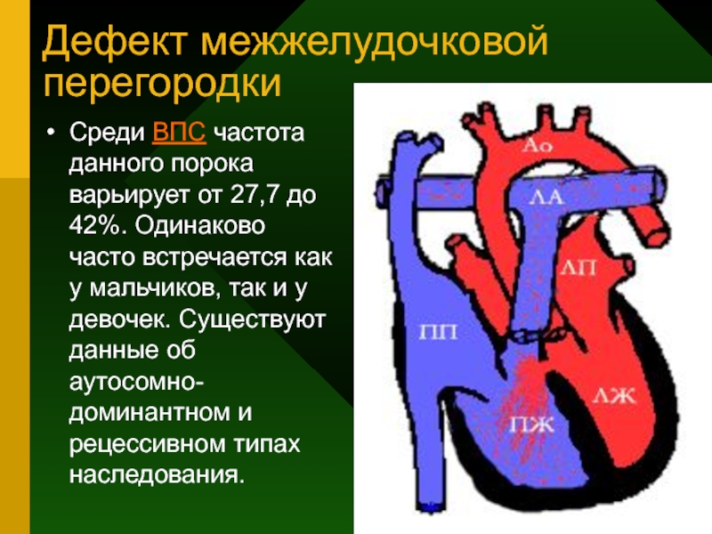 Дефект межжелудочковой. Врожденные пороки сердца дефект межжелудочковой перегородки. Врожденный порок сердца ДМЖП. Дефект межжелудочковой перегородки изолированный.