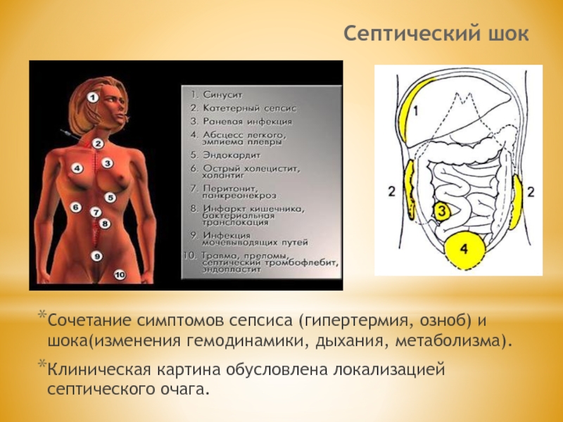 Септический шок картинки