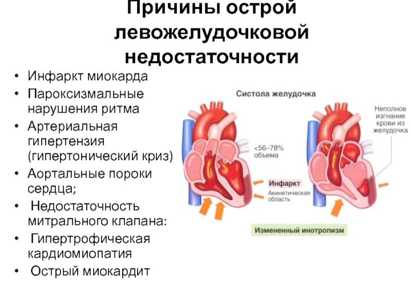 Норма сердечной недостаточности. Хроническая левожелудочковая сердечная недостаточность патогенез. ХСН правожелудочковая недостаточность. Острая левожелудочковая недостаточность гемодинамика. Левожелудочковая недостаточность схема.