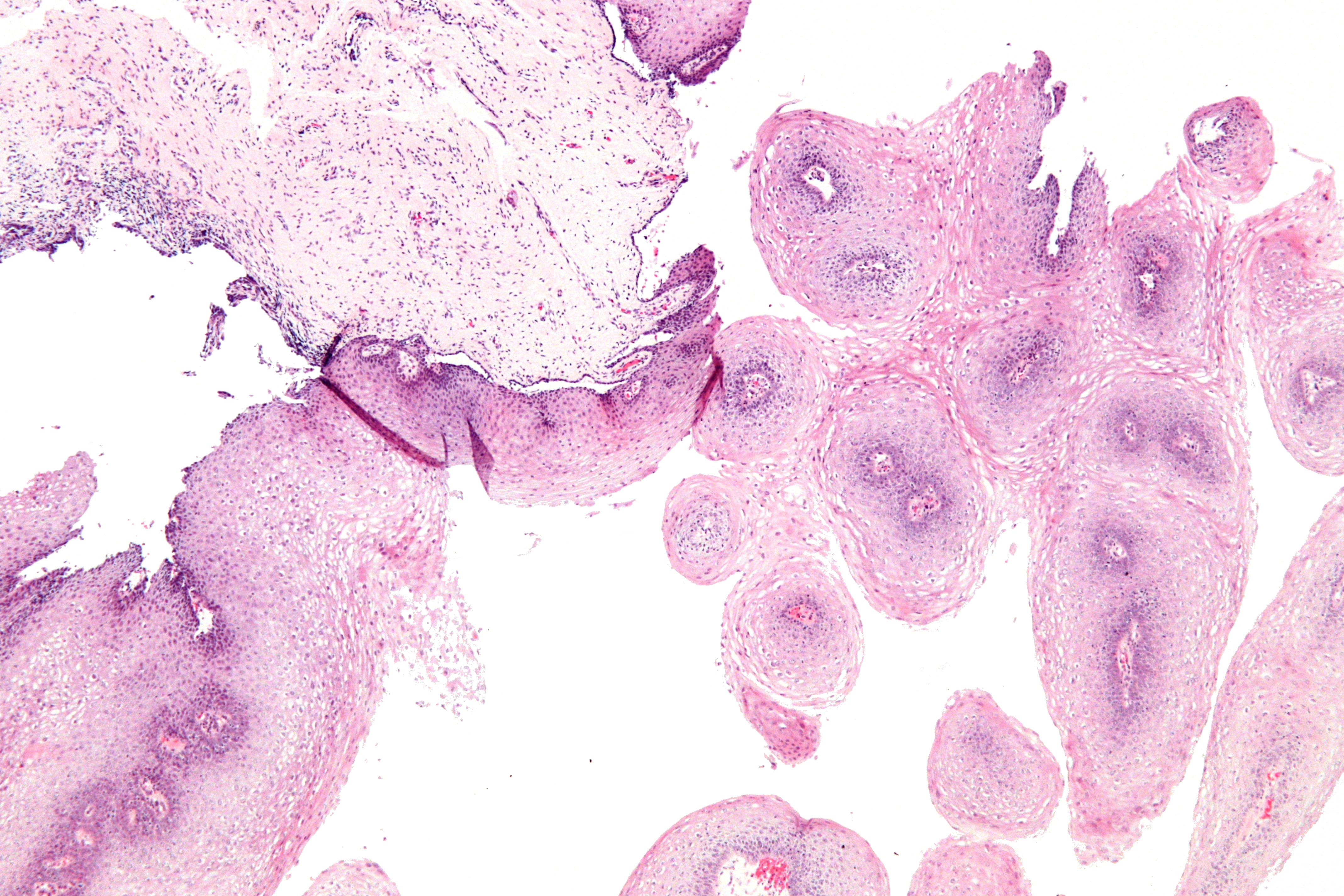 Рак наружных половых органов. Кондиломы (condylomata acuminata);. Остроконечные остроконечные кондиломы. Кондилома Бушке Левенштейна. Остроконечная кондилома гистология.