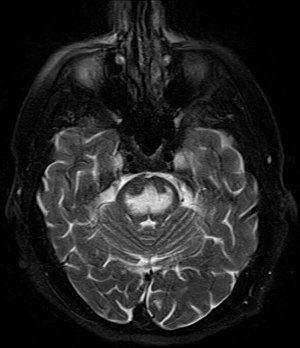 MRI Central Pontine myelinolyse vet zat T2.jpg
