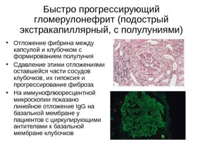 быстропрогрессирующий гломерулонефрит