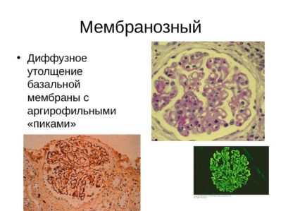 Мембранозный гломерулонефрит