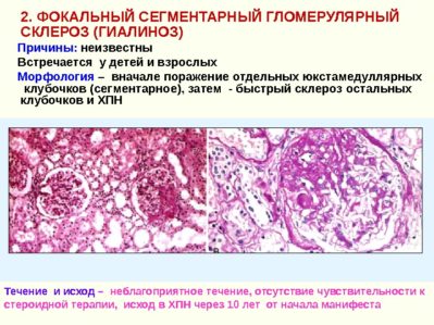 Фокально-сегментарный гломерулосклероз