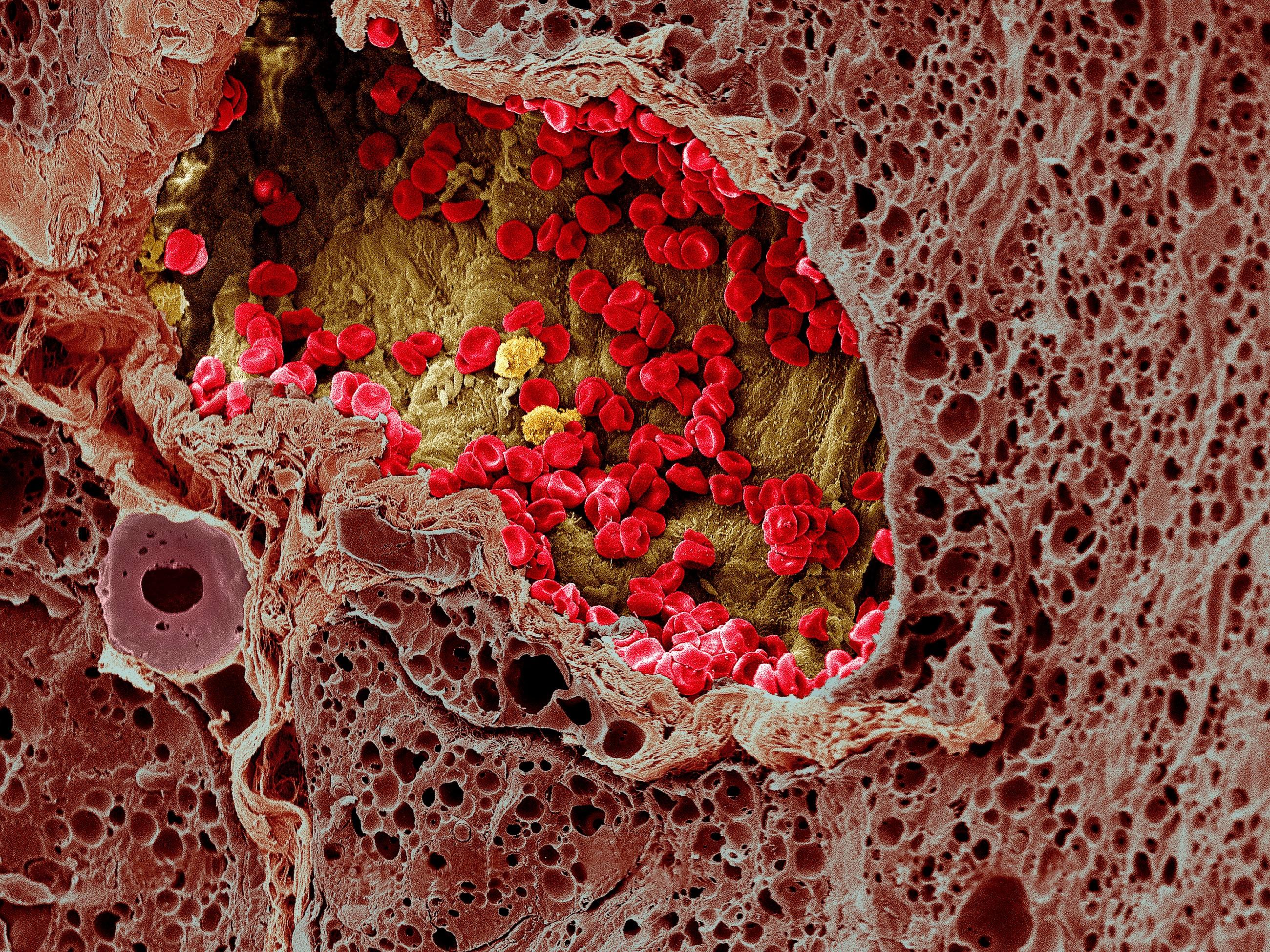 Злокачественное новообразование мозга. Микрофотография костного мозга. Раковые клетки под микроскопом. Опухолевые клетки микроскоп.
