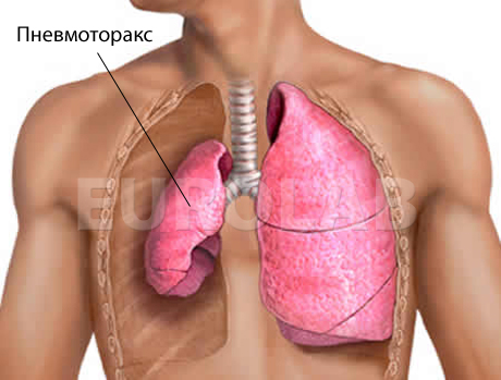 Пневмоторакс у детей