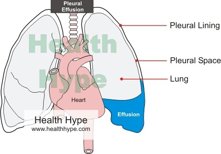 Fluid around the Lung