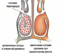 Вазомоторный ринит