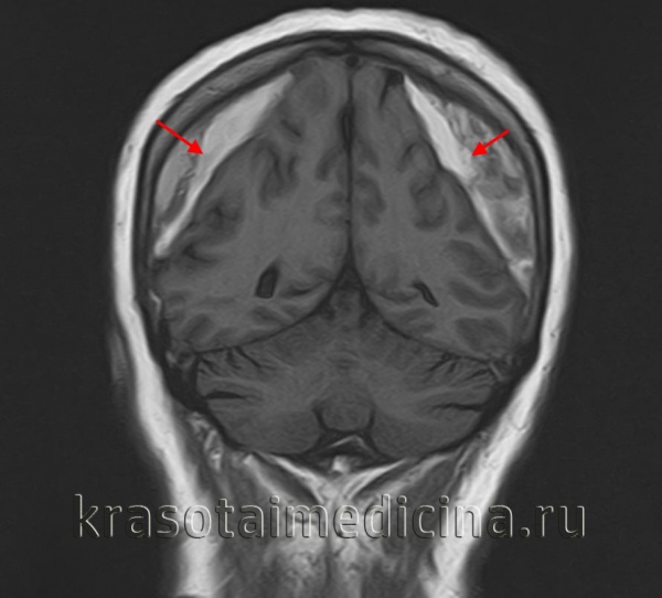 МРТ головного мозга. Массивная двухсторонняя хроническая субдуральная гематома.