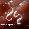 Симптомы паразитарных инфекций - MY-DOKTOR.RU