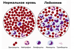 Диагностика рака крови